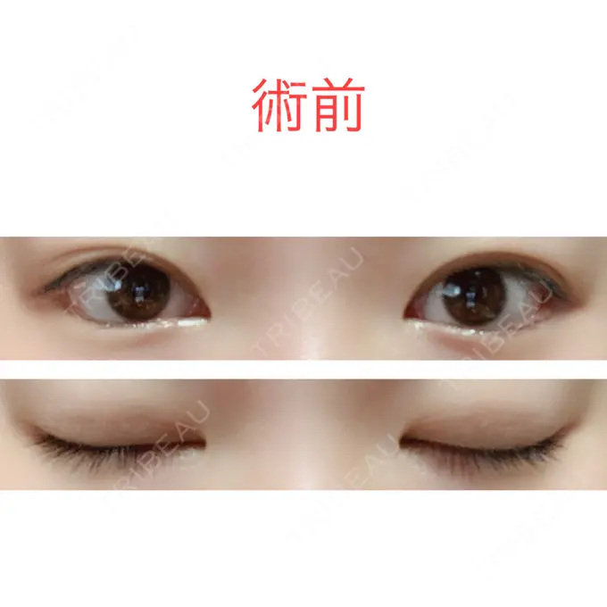 二重切開 水の森美容クリニック 東京新宿院 BEFORE メイン用