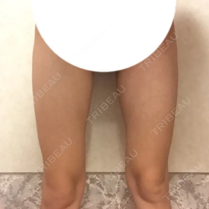 脂肪溶解注射（太もも） 湘南美容クリニック 仙台院 BEFORE メイン用