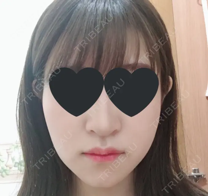 バッカルファット除去 / 脂肪吸引（顔） / ヒアルロン酸注入（あご） / レディエッセ注入（あご） / ボトックス（エラ・小顔） / その他（輪郭） エートップ美容整形外科 BEFORE メイン用