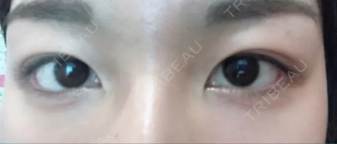 二重埋没 湘南美容クリニック 京都院 BEFORE メイン用