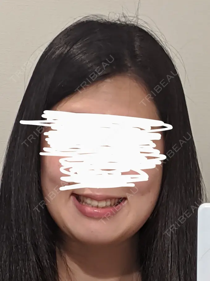 バッカルファット除去 静岡美容外科橋本クリニック BEFORE メイン用