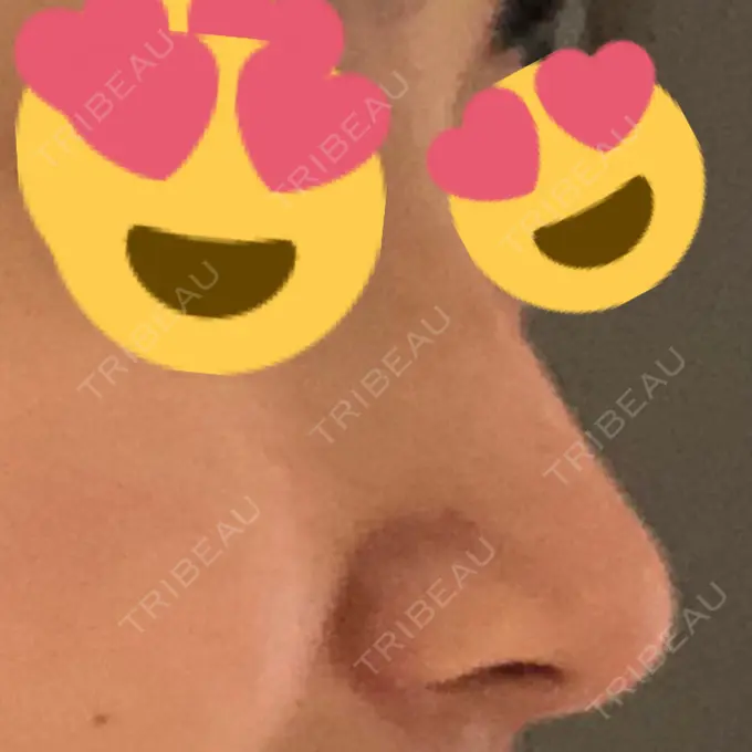 その他（鼻） ヴェリテクリニック 銀座院 BEFORE メイン用