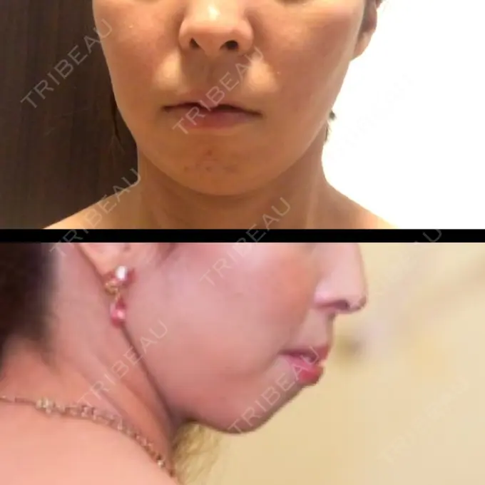 あごプロテーゼ ティーズクリニック BEFORE メイン用