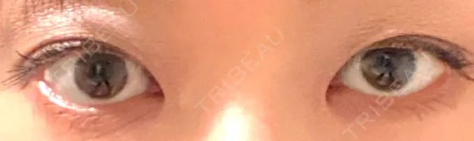 二重切開 / 目頭切開 きくな湯田眼科 BEFORE メイン用