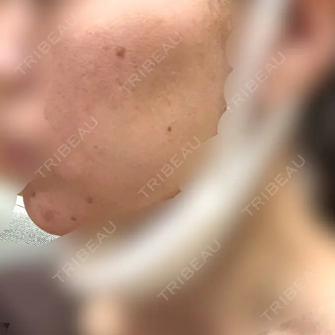 ピーリング（ニキビ・毛穴） / ピコレーザートーニング（美白・肝斑） / YAGレーザー 赤坂ビューティークリニック BEFORE メイン用