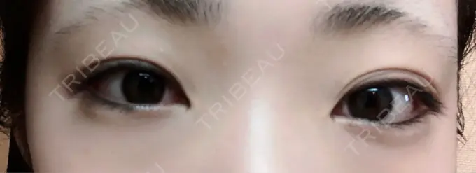 二重埋没 十仁美容整形 BEFORE メイン用