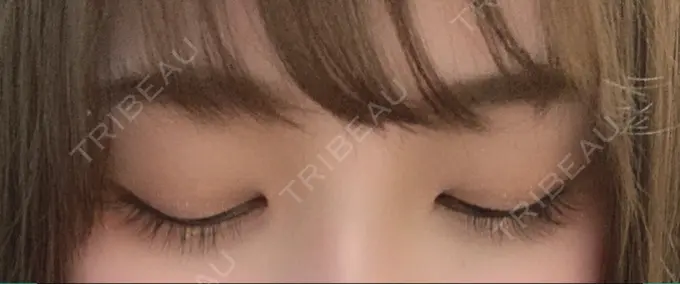 二重埋没 湘南美容クリニック 赤坂見附院 BEFORE メイン用