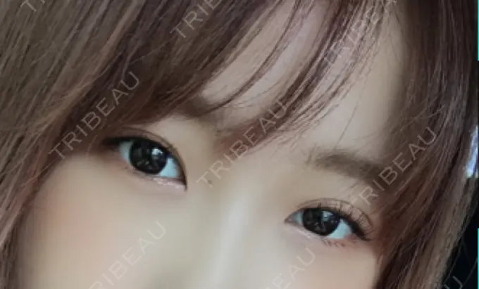 ヒアルロン酸注入（涙袋） しのぶ皮膚科 BEFORE メイン用