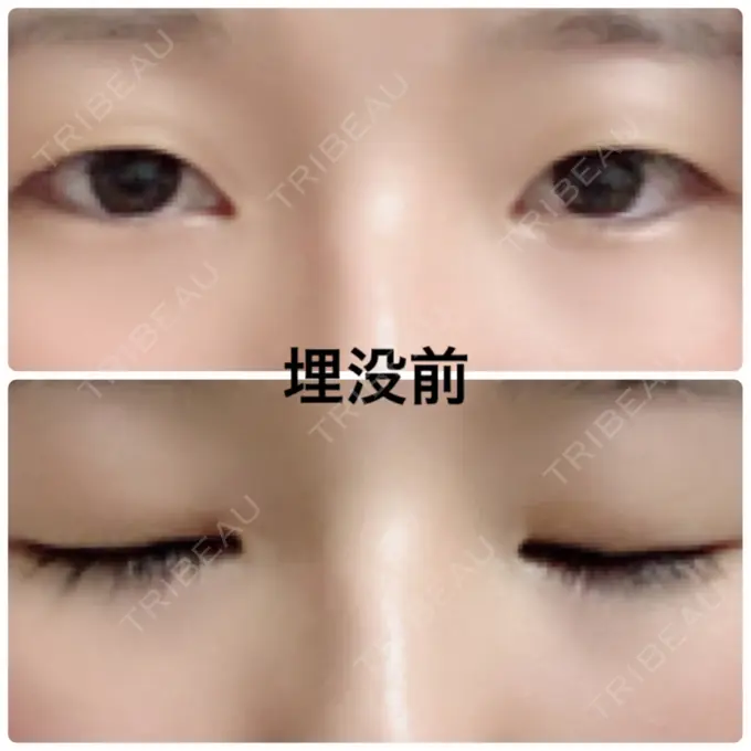 二重埋没 湘南美容クリニック 京都院 BEFORE メイン用