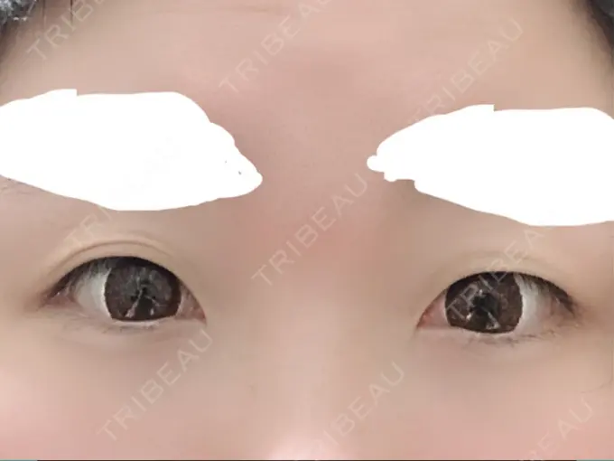 二重埋没 湘南美容クリニック 姫路院 BEFORE メイン用