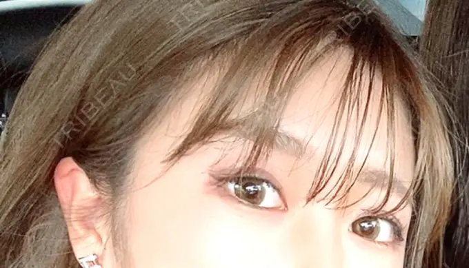 二重埋没 Wクリニック 心斎橋院 BEFORE メイン用