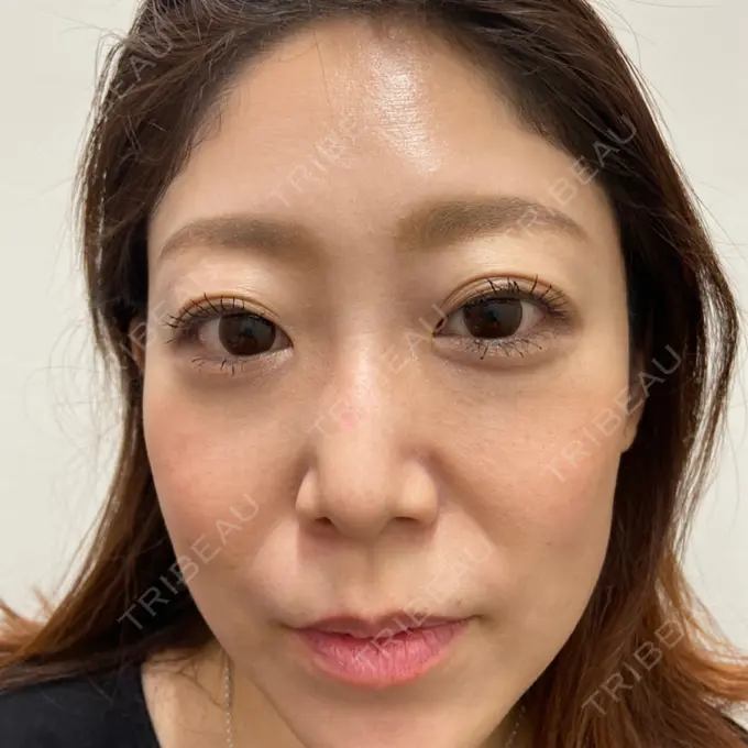 糸リフト 大阪TAクリニック BEFORE メイン用