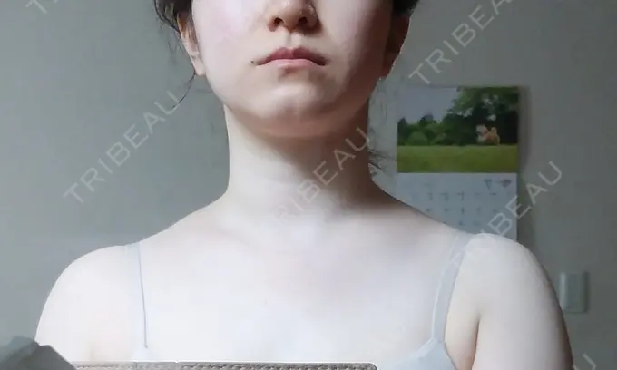 ボトックス（肩） もとび美容外科クリニック 新宿院 BEFORE メイン用