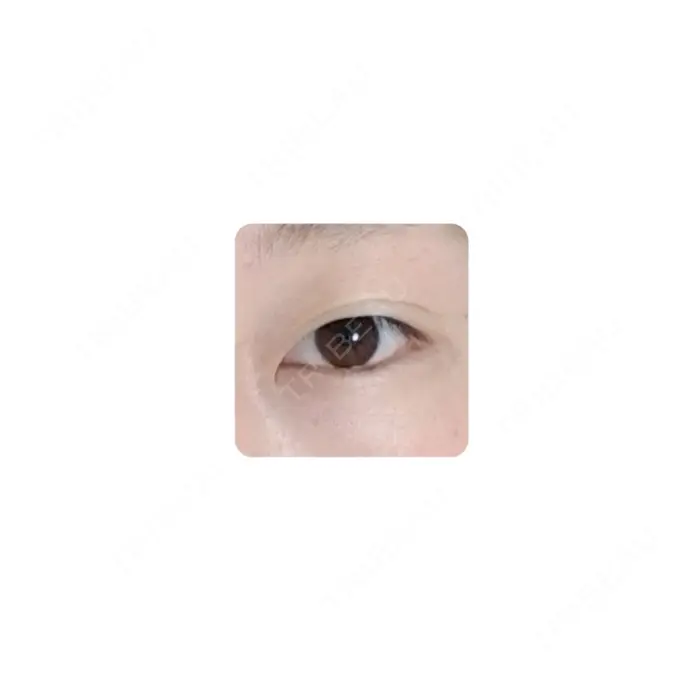 二重切開 カリスクリニック BEFORE メイン用