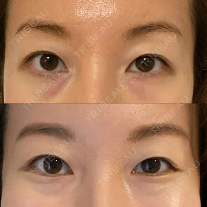 クマ治療 X CLINIC 恵比寿院 BEFORE メイン用