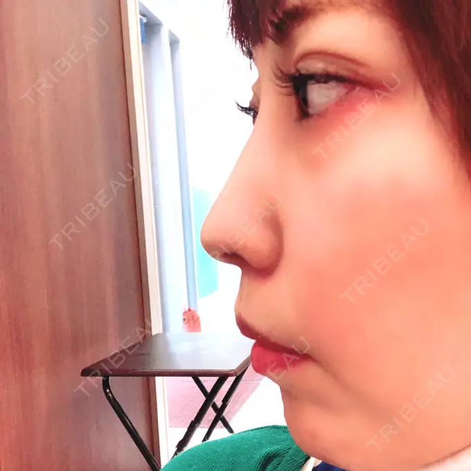 二重切開 / ヒアルロン酸注入（鼻） 品川スキンクリニック沖縄院 BEFORE メイン用