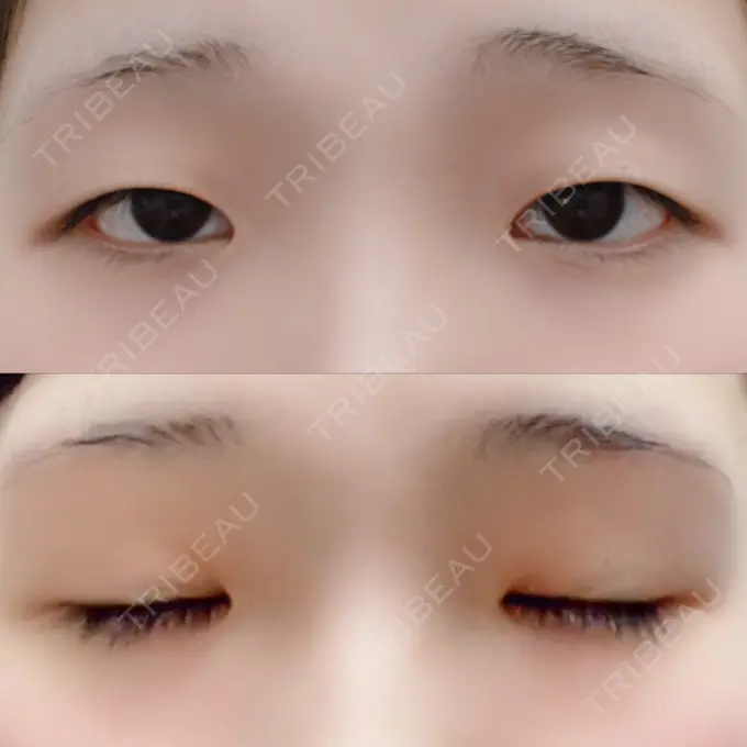 二重埋没 湘南美容クリニック 赤坂見附院 BEFORE メイン用