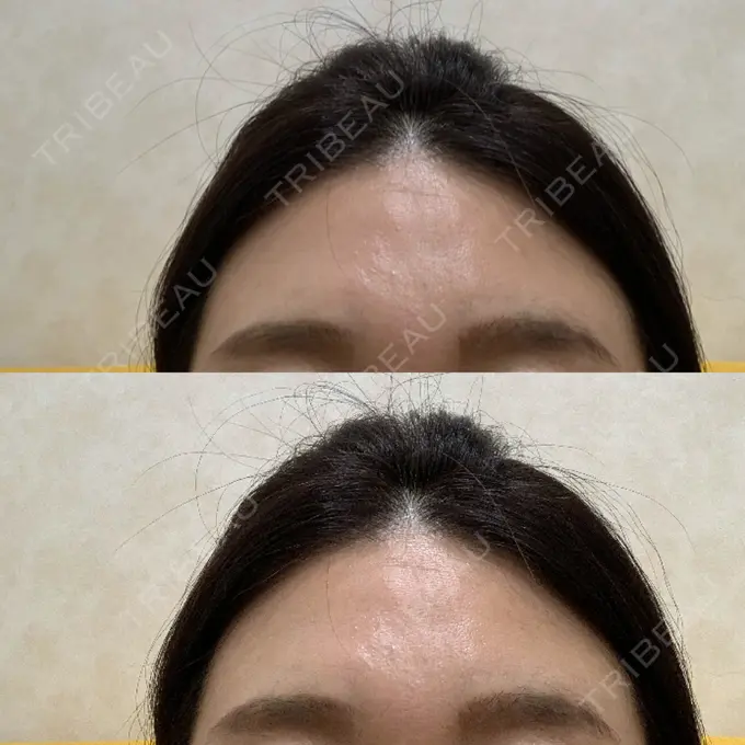 額を丸く / シワ取りボトックス 銀座3丁目・BANNAI美容クリニック BEFORE メイン用