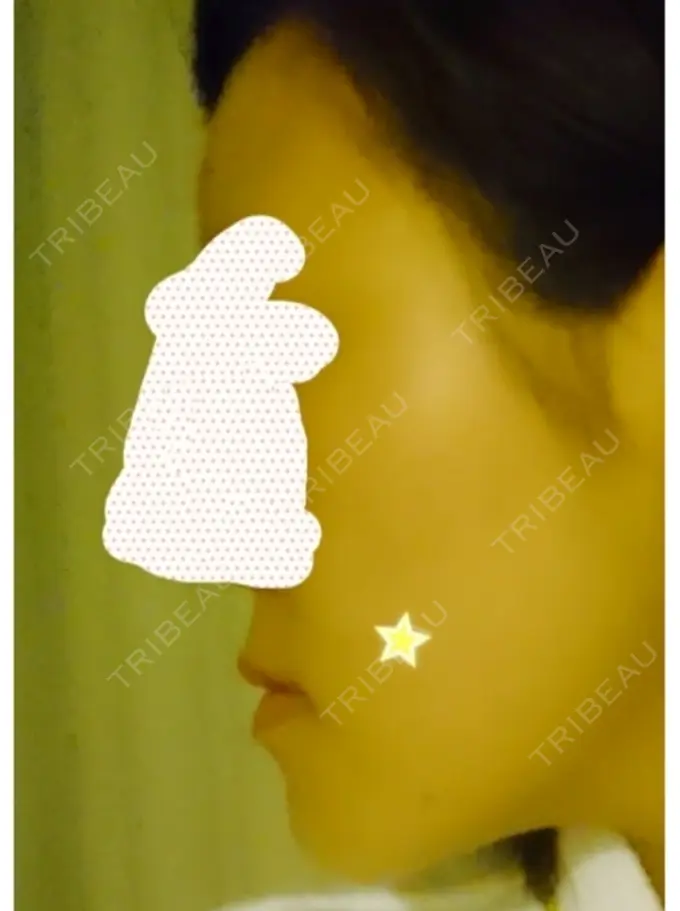 骨切り（あご） / ルフォー+ssro（両あご) id（アイディ）美容外科 BEFORE メイン用