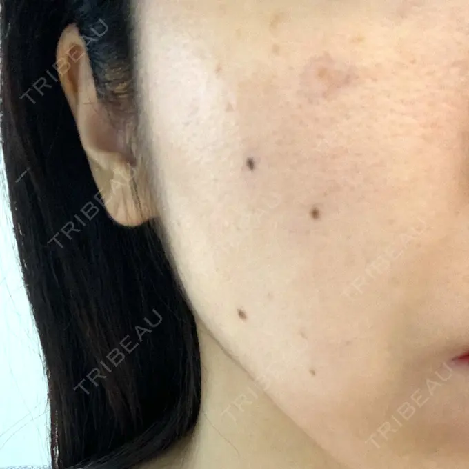 シミ取りレーザー Dual Clinic KOBE BEFORE メイン用