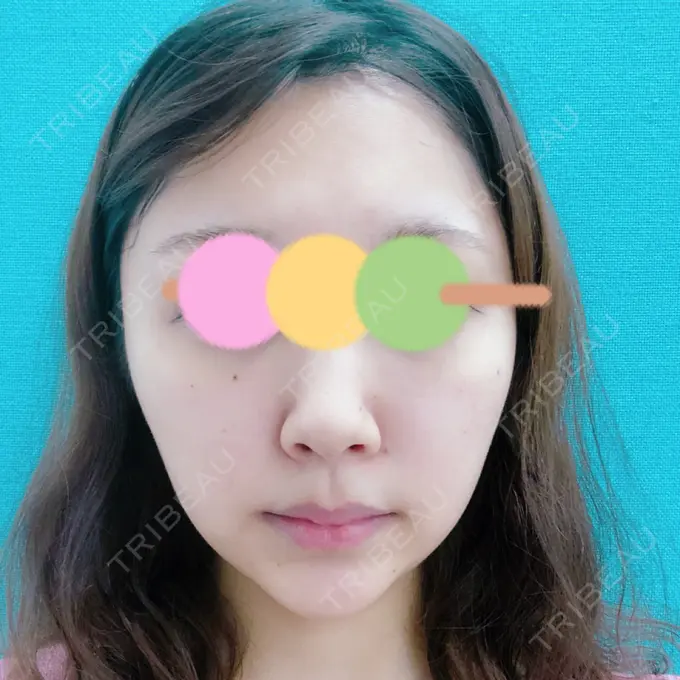 鼻尖形成（切開） / 小鼻縮小（切開） みずほクリニック BEFORE メイン用