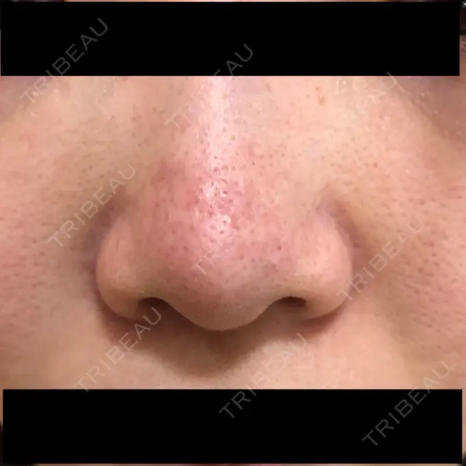 ピーリング（ニキビ・毛穴） / 美肌レーザー みやた形成外科・皮ふクリニック BEFORE メイン用