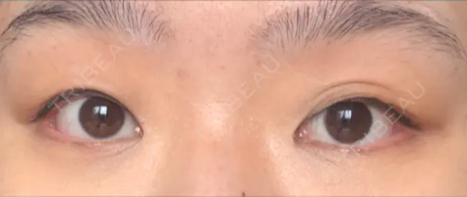 二重切開 / 目頭切開 Wクリニック 心斎橋院 BEFORE メイン用