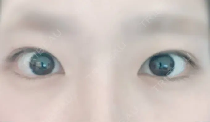 二重切開 有楽町高野美容クリニック BEFORE メイン用