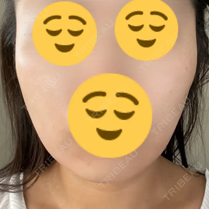 脂肪溶解注射（顔） ビクアスクリニック BEFORE メイン用