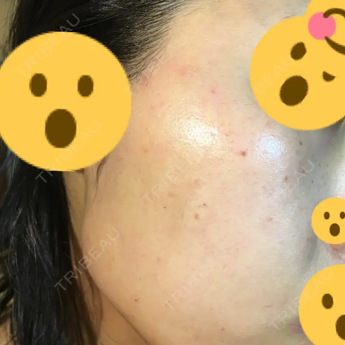 ピコレーザートーニング（美白・肝斑） UB CLINIC銀座 BEFORE メイン用