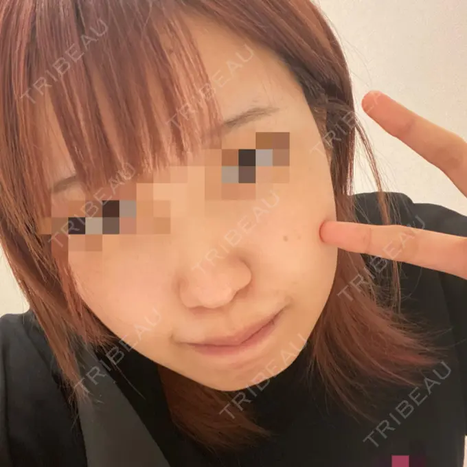 脂肪溶解注射（顔） TCB東京中央美容外科 心斎橋筋院 BEFORE メイン用