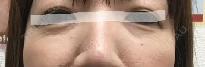 ボトックス（あご） TCB東京中央美容外科 宇都宮院 BEFORE メイン用