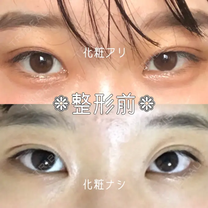 二重埋没 城本クリニック 福岡院 BEFORE メイン用