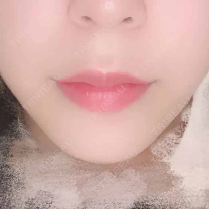 人中短縮 / PRP皮膚再生療法 BIANCA銀座 BEFORE メイン用