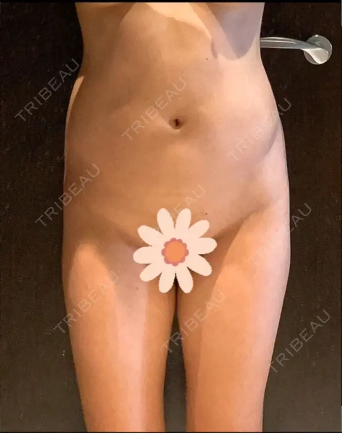 脂肪吸引（お腹） WOM CLINIC GINZA （ワム クリニック ギンザ） BEFORE メイン用