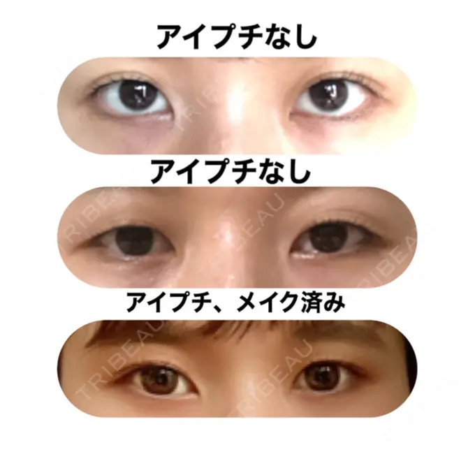 二重埋没 湘南美容クリニック 赤坂見附院 BEFORE メイン用