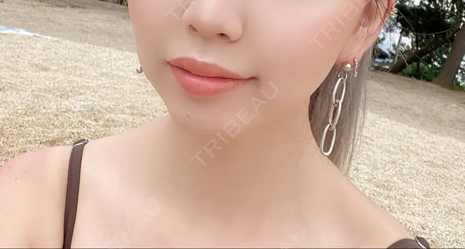 糸リフト / バッカルファット除去 / ボトックス（エラ・小顔） TCB東京中央美容外科 堺院 BEFORE メイン用