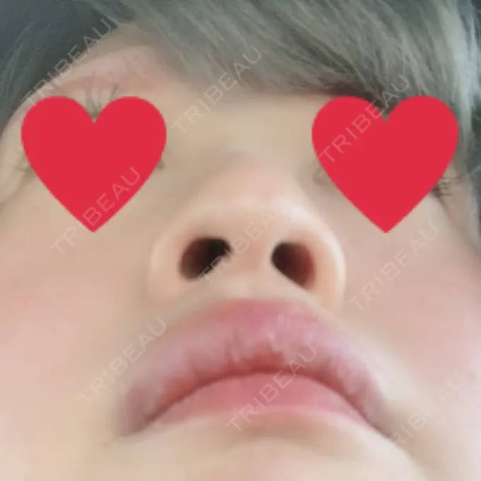 小鼻縮小（切開） / 鼻尖縮小 グレーススキンクリニック BEFORE メイン用