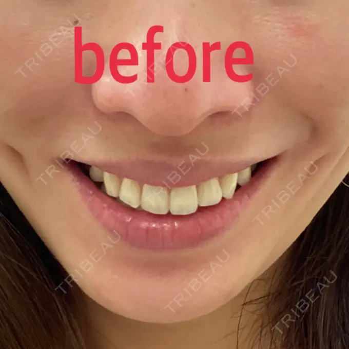 ボトックス（エラ・小顔） / ハイフ（顔） TCB東京中央美容外科 中野院 BEFORE メイン用