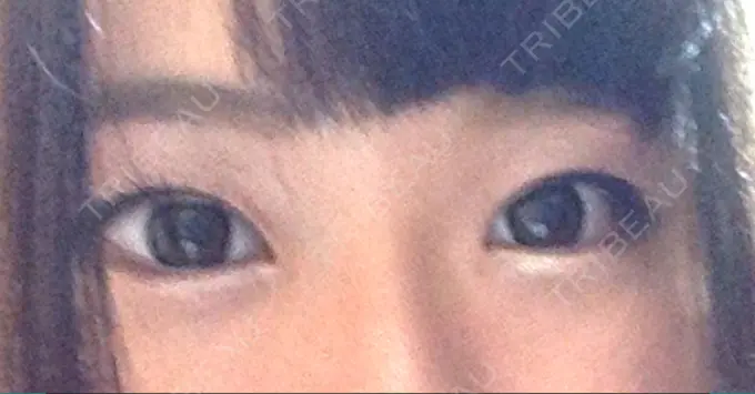 二重切開 きくな湯田眼科 BEFORE メイン用