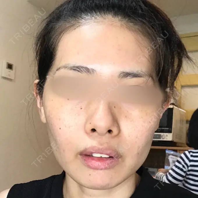 糸リフト / ヒアルロン酸注入（あご） / ボトックス（エラ・小顔） / 脂肪溶解注射（顔） / その他（鼻） 大阪TAクリニック BEFORE メイン用