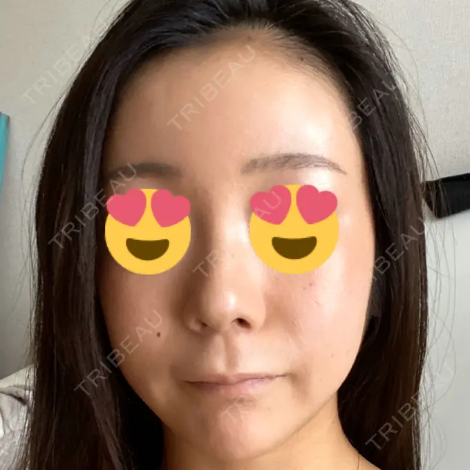 タレ目形成・グラマラスライン（切開） / 切開リフト ドクターゴールドマンクリニック 東京高輪院 BEFORE メイン用