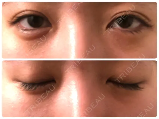 眼瞼下垂（切開） Taide Suenaga Clinic（タイデスエナガクリニック） BEFORE メイン用
