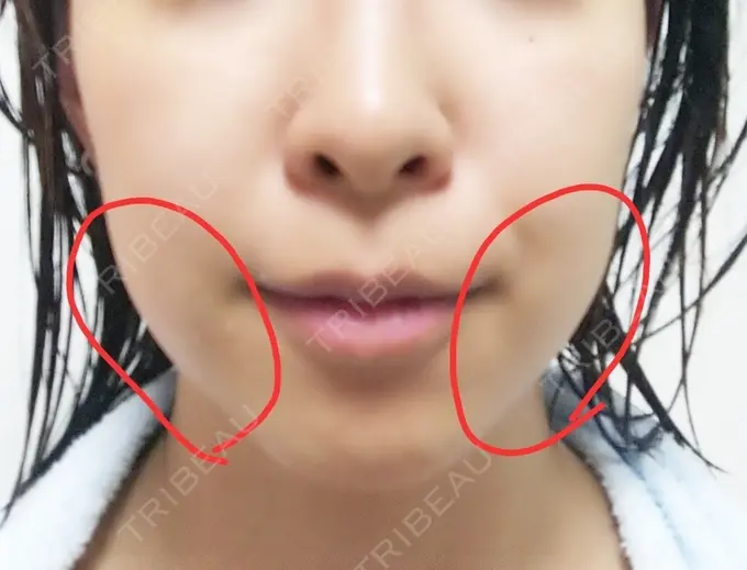 脂肪溶解注射（顔） 新宿美容外科クリニック 新宿院 BEFORE メイン用