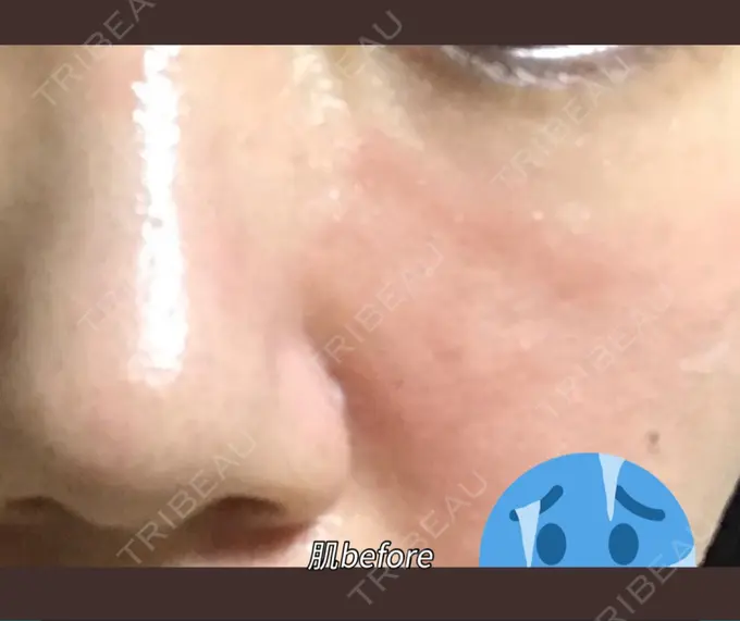 ハイフ（顔） / イオン導入 湘南美容クリニック 名古屋栄院 BEFORE メイン用