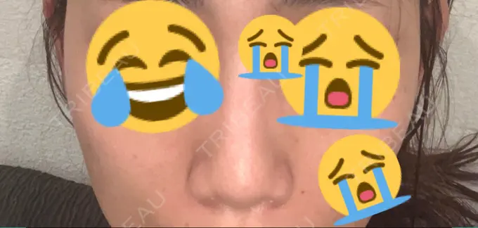 鼻尖形成（切開） / 軟骨移植 THE ROPPONGI CLINIC（ザ 六本木クリニック） BEFORE メイン用