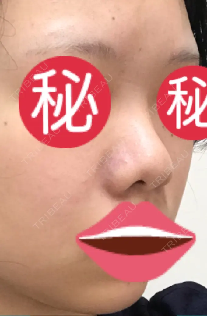 隆鼻術 / 鼻中隔延長（切開） / 鼻尖縮小 みずほクリニック BEFORE メイン用