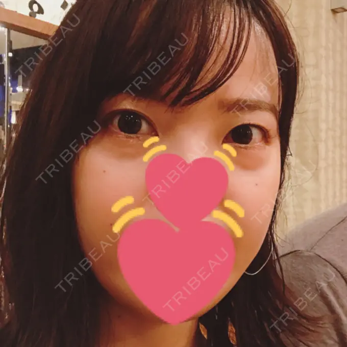 脂肪溶解注射（まぶた） / PRP皮膚再生療法 プルージュ美容クリニック 赤羽院 BEFORE メイン用