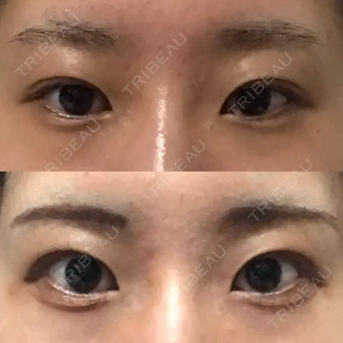 目尻切開 / タレ目形成・グラマラスライン（切開） A CLINIC（エークリニック） 銀座院 BEFORE メイン用