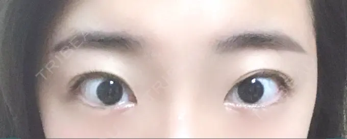 二重埋没 恵聖会クリニック 京橋院 BEFORE メイン用